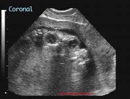 Image result for Anencephaly Sagittal Section On Ultrasound