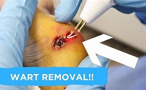 Image result for Burn Wart