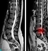 Image result for MRI Scan Lumbar Spine