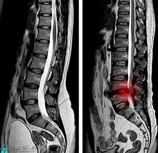 Image result for Normal MRI Lower Lumbar Spine
