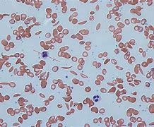 Image result for Sickle Cell Anemia Blood Smear