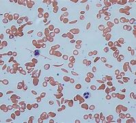 Image result for Sickle Cell Blood Smear