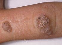 Image result for Warts On Skin Caused by HPV