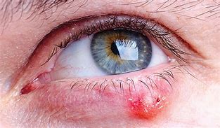 Image result for Sebaceous Cyst Eyelid