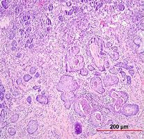 Image result for Cervical Cancer Histology