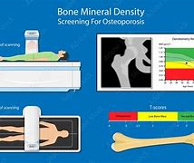 Image result for Bone Mineral Density Osteoporosis