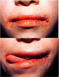 Image result for Mouth Allergy
