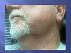 Image result for Skin Cancer Neck