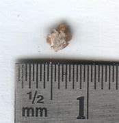 Image result for Kidney Stones Passed