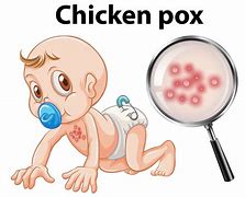 Image result for Chicken pox Cartoon