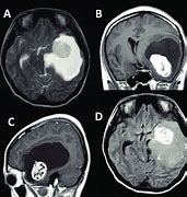 Image result for 8 Cm Tumor