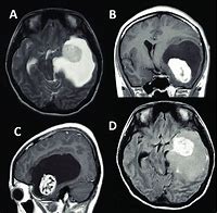 Image result for 1 Cm Tumor