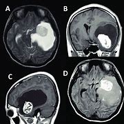 Image result for 16 Cm Tumor
