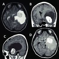 Image result for 2 Centimeter Tumor