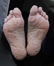Image result for Trench Foot WW1