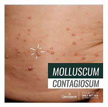 Image result for Molluscum Contagiosum HIV