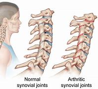 Image result for Cervical Spine Arthritis