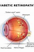 Image result for What Is the Retina