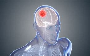 Image result for Brain Cancer Moving Animation