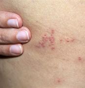 Image result for Common Bed Bug Bites
