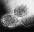Image result for Molluscum Virus