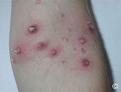 Image result for Molluscum Contagiosum in Tagalog