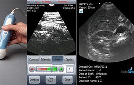 Image result for Portable Ultrasound Scanner