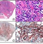 Image result for Basal Cell Papilloma