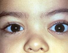 Image result for Leukemia Eyes