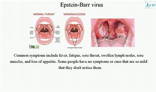 Image result for Mono Tonsils