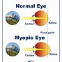 Image result for Myopia Letters