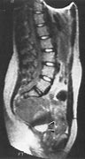 Image result for Sacral Meningocele Radiology