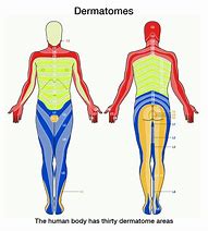 Image result for Shingles Dermatome Pattern