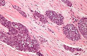 Image result for Desmoplastic Small Round Cell Tumor