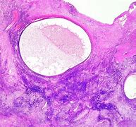 Image result for 8 Cm Ovarian Cyst
