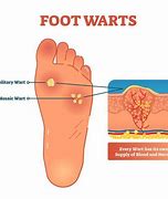 Image result for Plantar Wart Cut Out