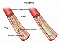 Image result for Carotid Angioplasty and Stenting Protective Cap