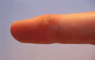Image result for Molluscum Contagiosum Warts