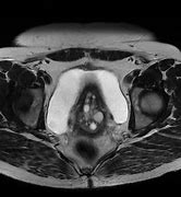 Image result for Genital Cyst