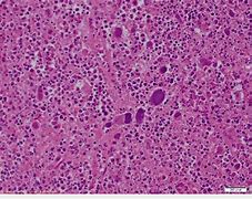 Image result for Inflammation On Left Side of Body