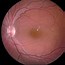 Image result for Retina Cyst