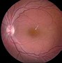 Image result for Macular Retinoschisis Oct