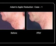 Image result for Death Adam S Apple's