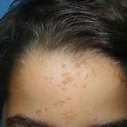 Image result for Wart Like Skin Tags Pictures