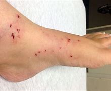 Image result for Raccoon Bite Marks