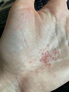 Image result for Scabies Bumps On Hands