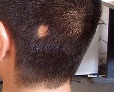 Image result for alopeciq