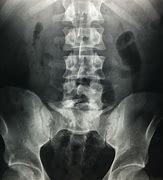 Image result for Spina Bifida Occulta of the L5 Vertebral Body