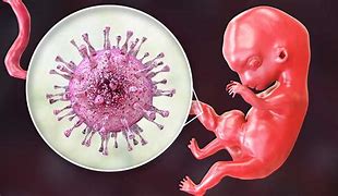Image result for Fetal Intrauterine Infection