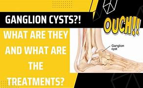 Image result for Midfoot Ganglion Cyst